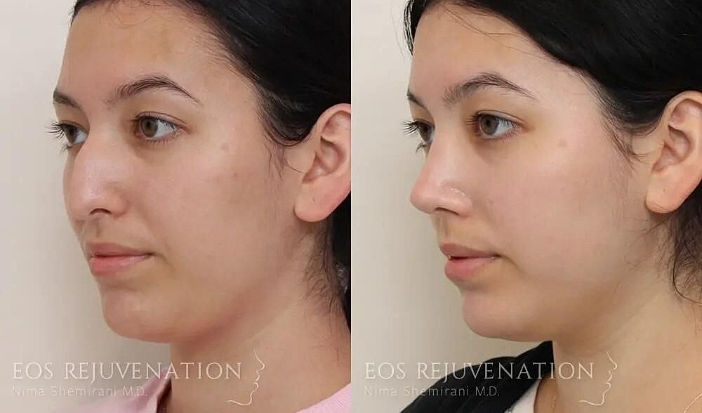 Rhinoplasty Before & After