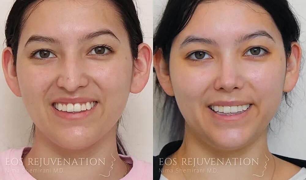 Rhinoplasty Before & After