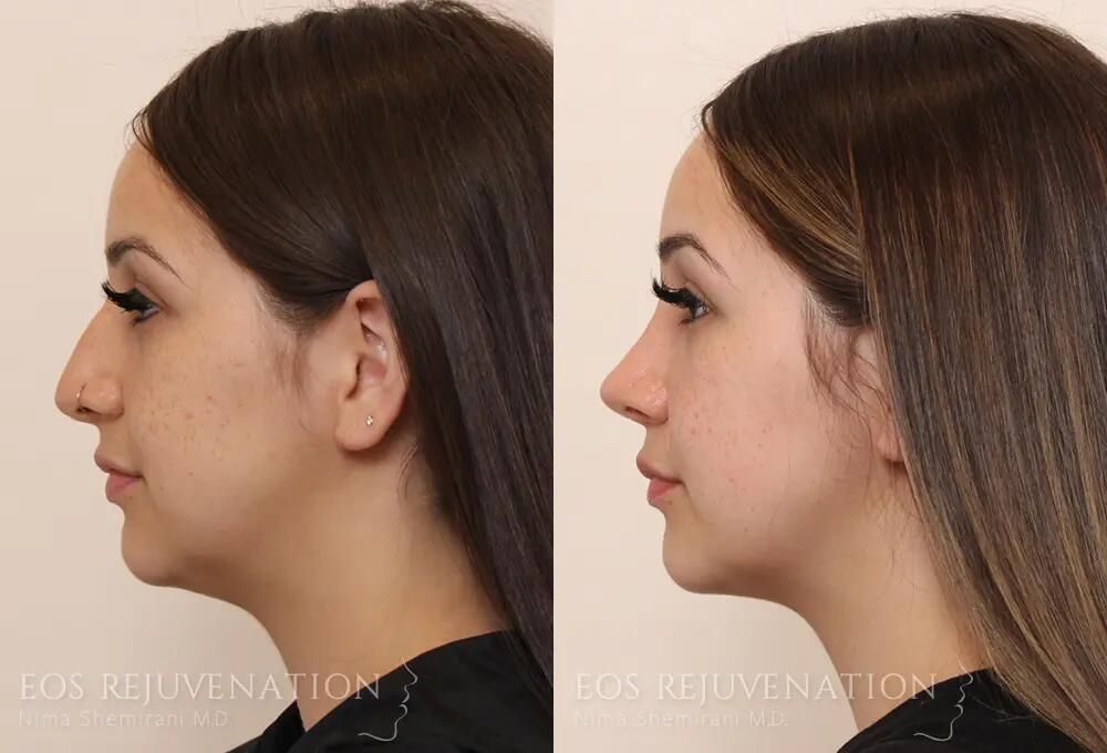 Rhinoplasty Before & After