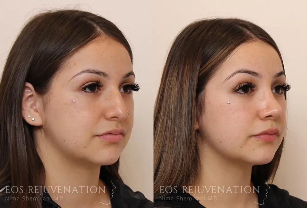 Rhinoplasty Before & After