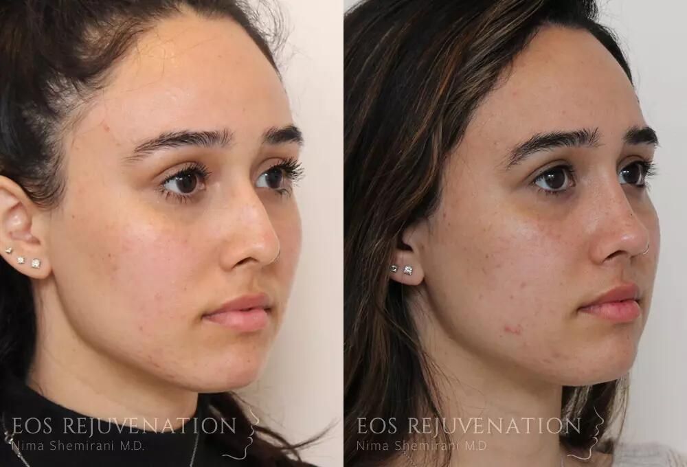 Rhinoplasty Before & After