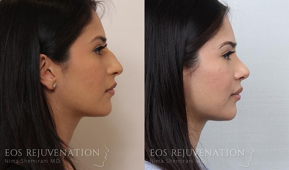 Rhinoplasty Before & After