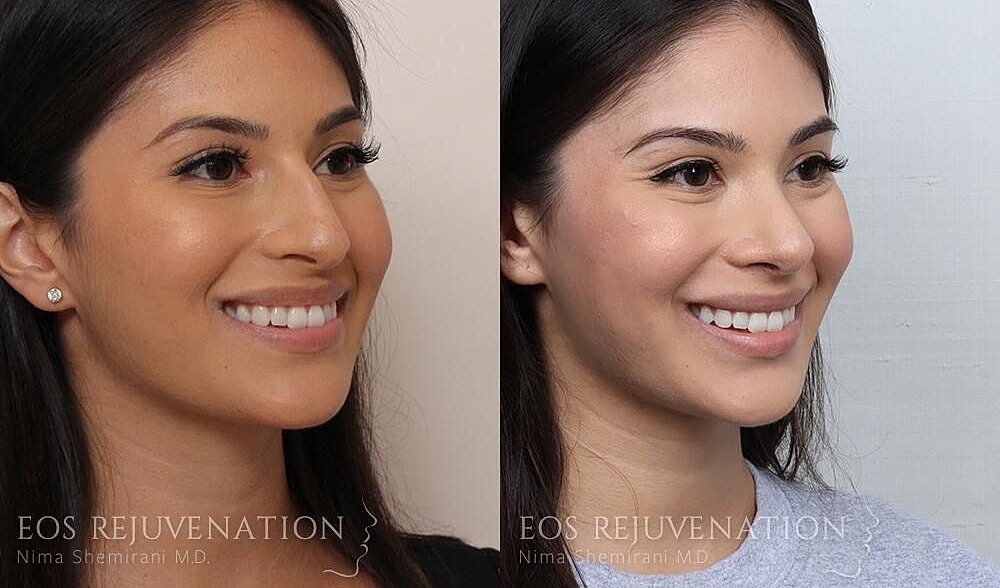 Rhinoplasty Before & After