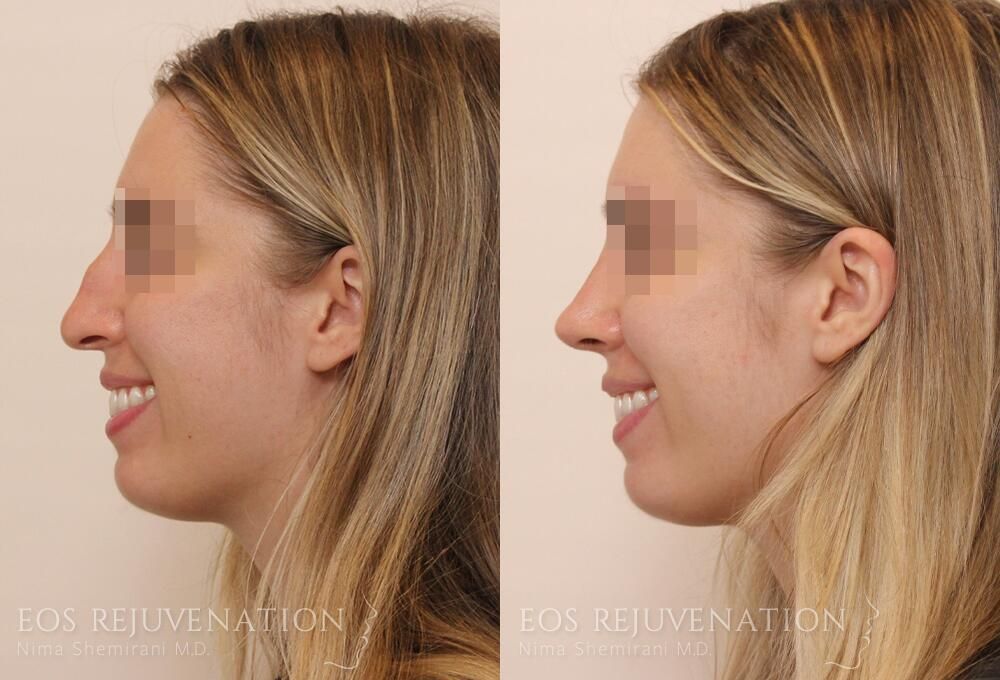 Rhinoplasty Before & After