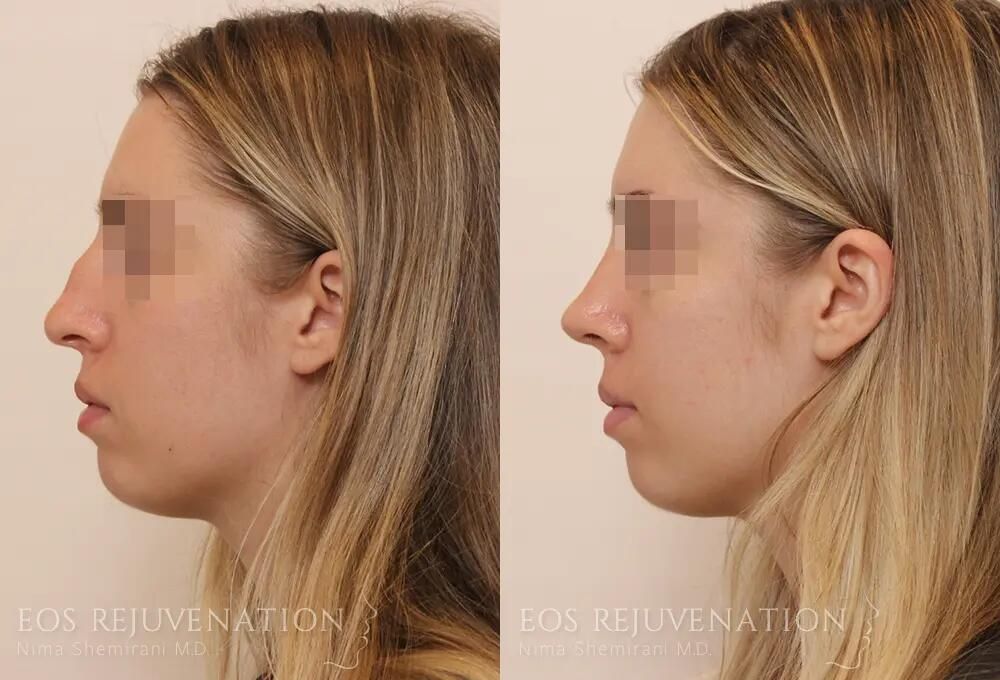 Rhinoplasty Before & After