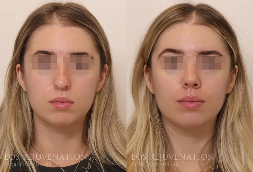 Rhinoplasty Before & After
