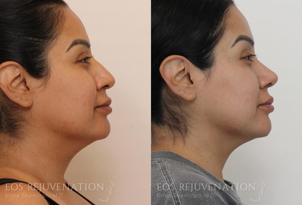 Rhinoplasty Before & After