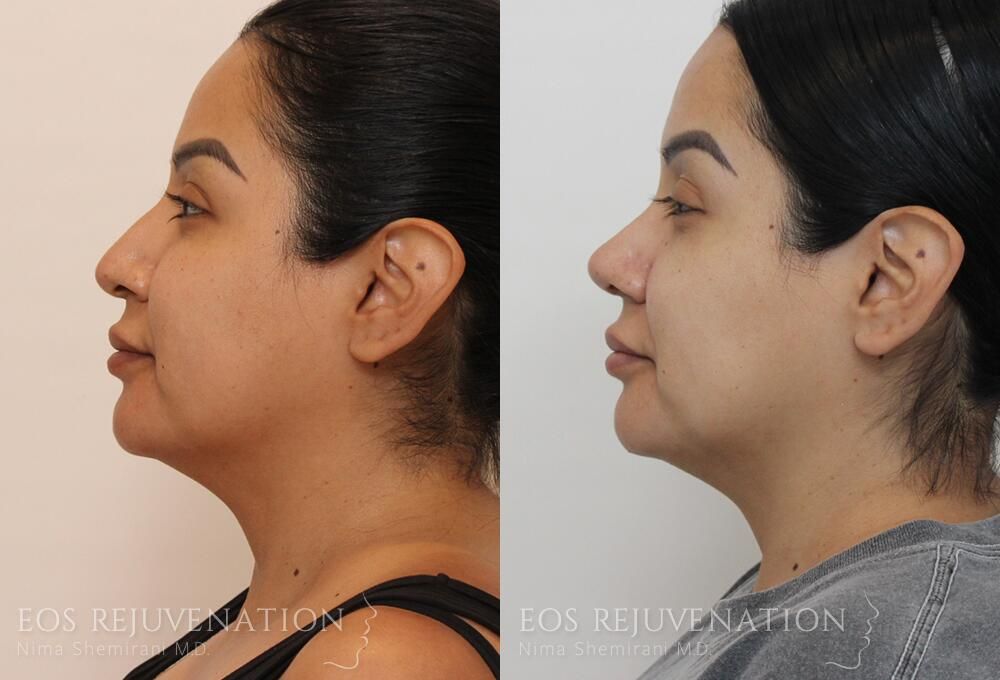 Rhinoplasty Before & After