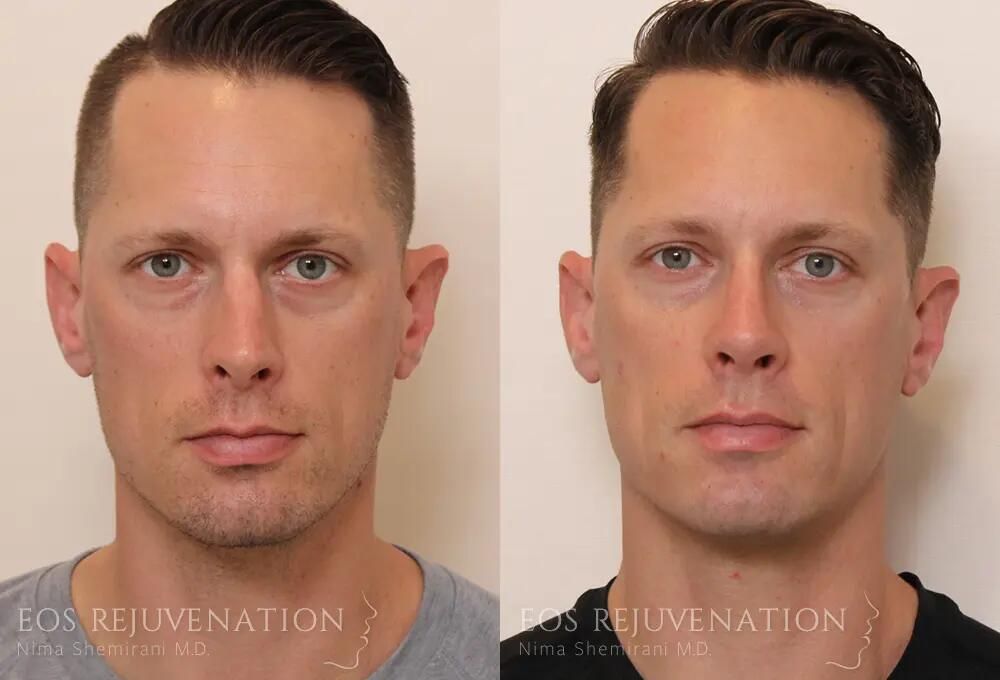 Rhinoplasty Before & After