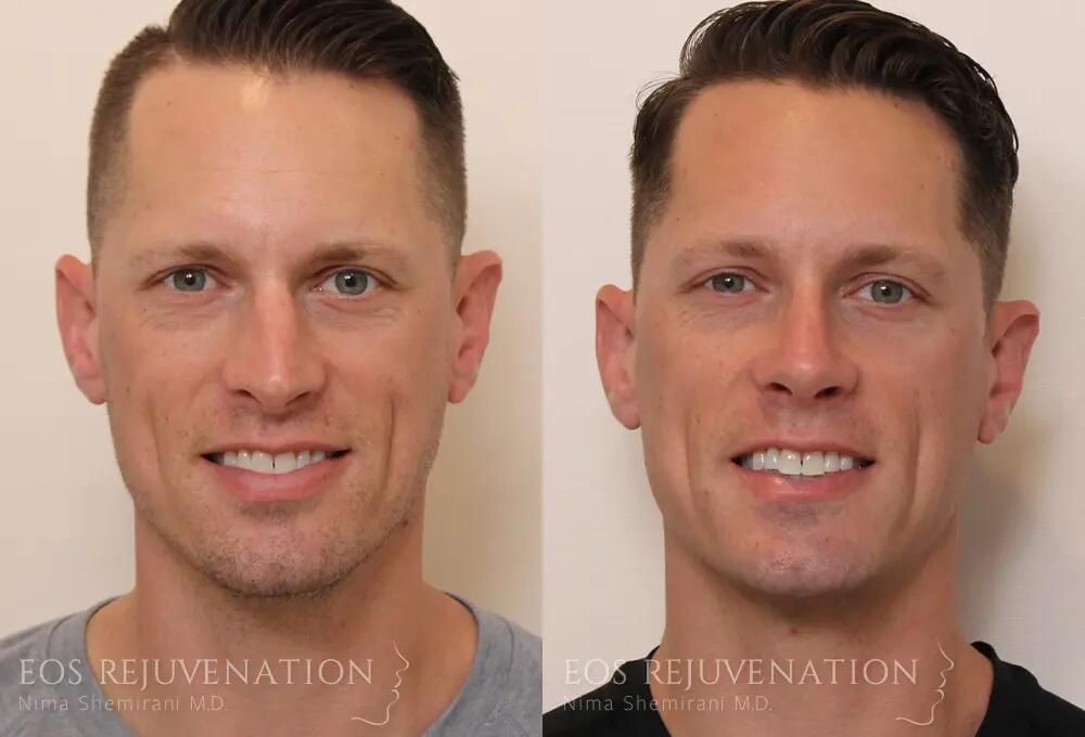 Rhinoplasty Before & After
