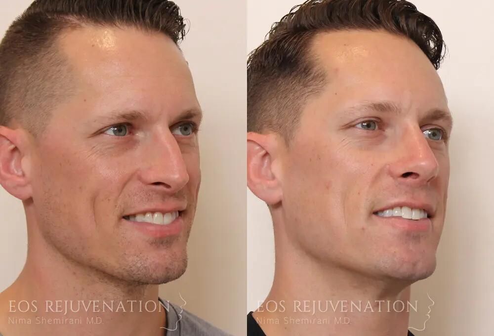 Rhinoplasty Before & After