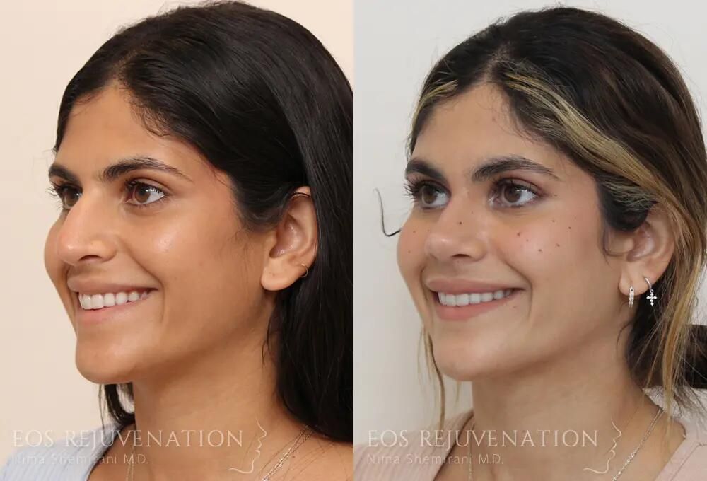Rhinoplasty Before & After