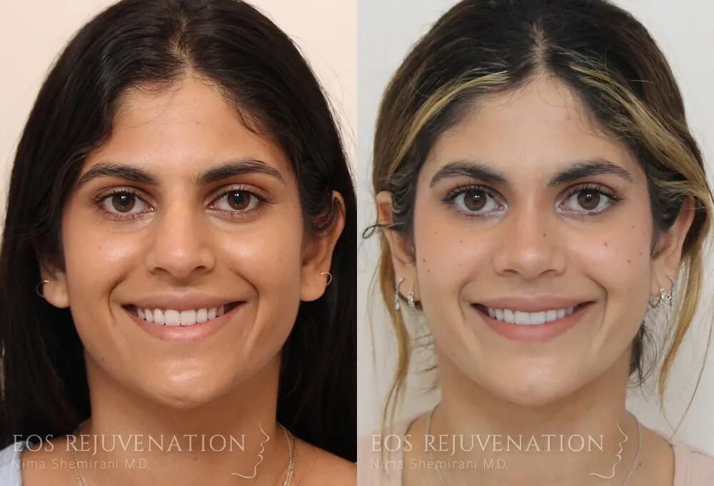Rhinoplasty Before & After