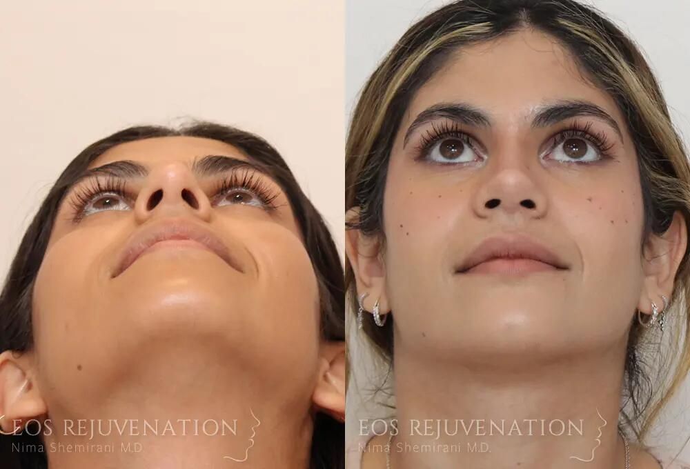 Rhinoplasty Before & After