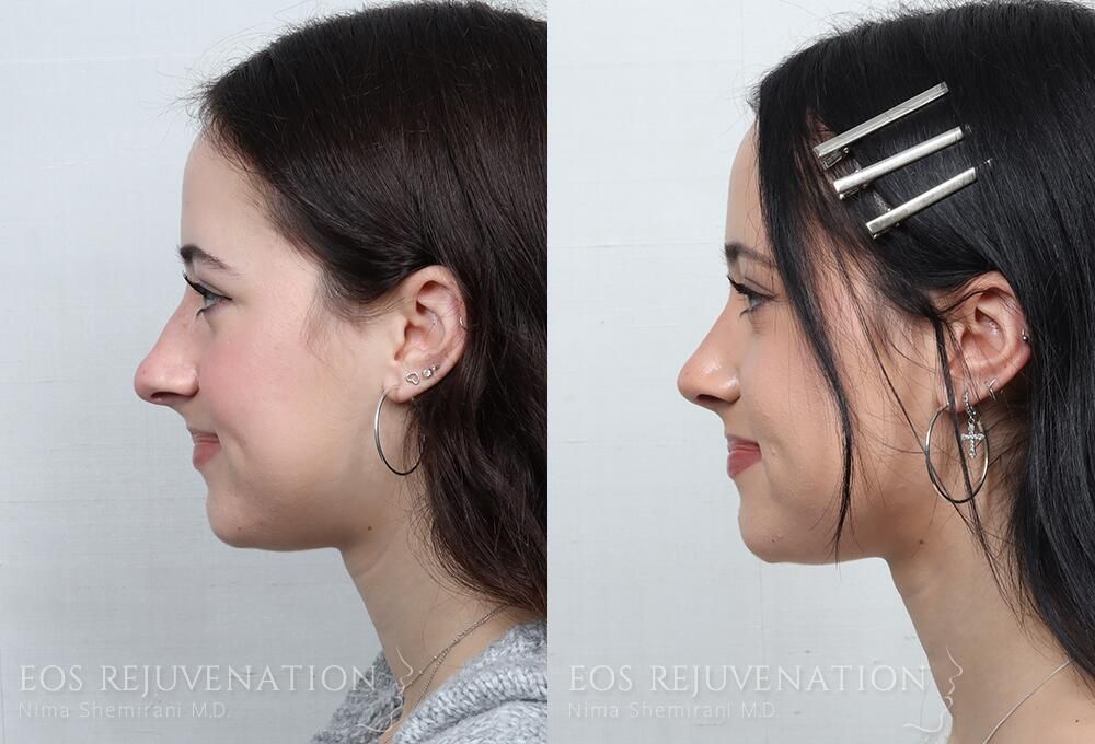Rhinoplasty Before & After