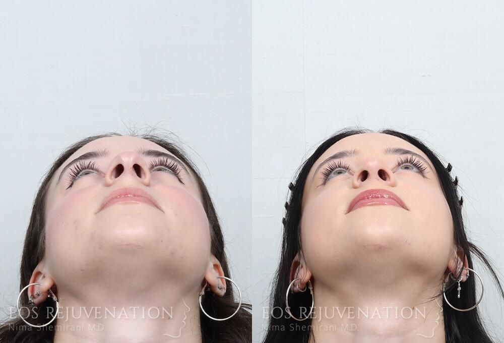 Rhinoplasty Before & After
