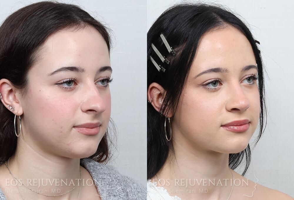 Rhinoplasty Before & After