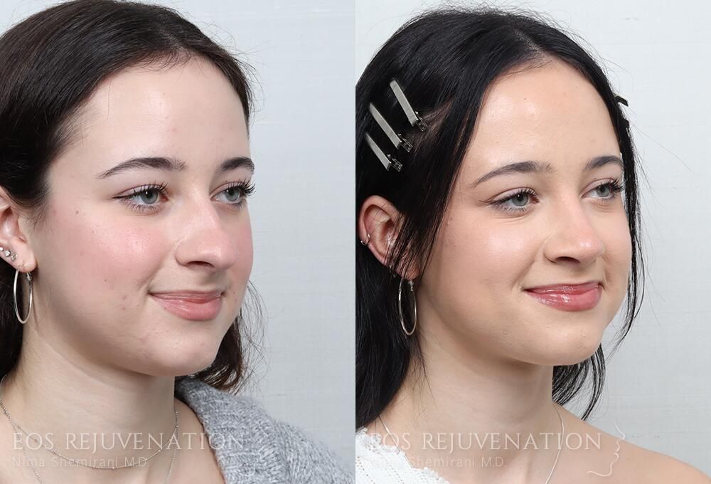 Rhinoplasty Before & After