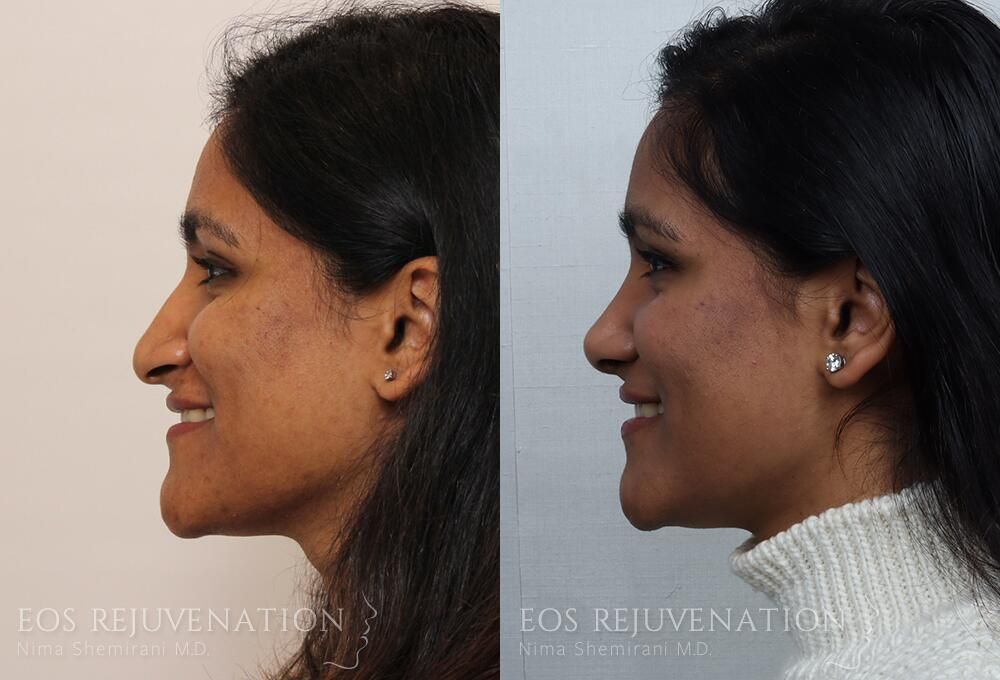 Rhinoplasty Before & After