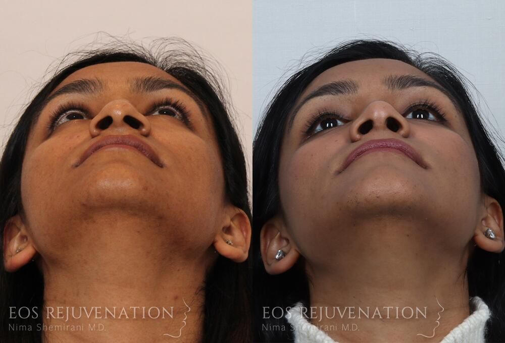 Rhinoplasty Before & After