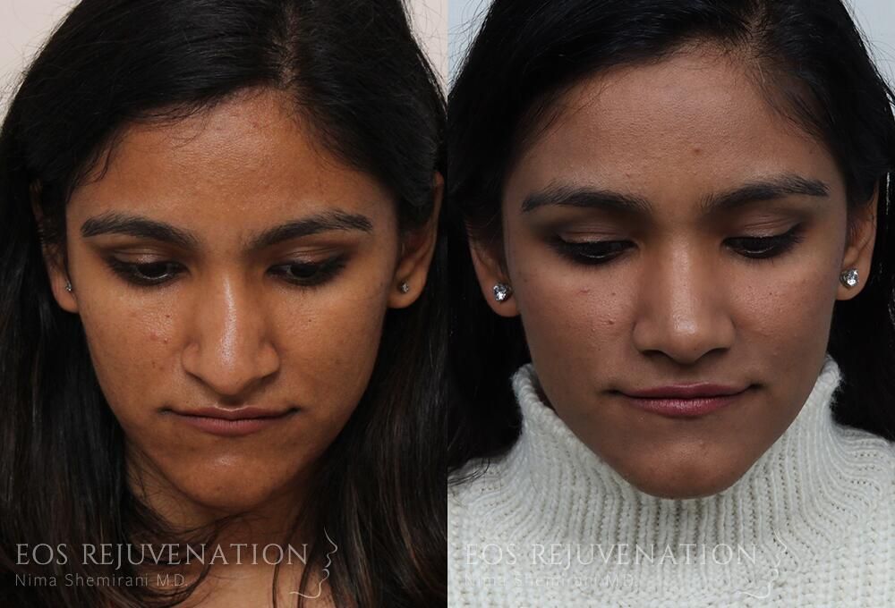 Rhinoplasty Before & After