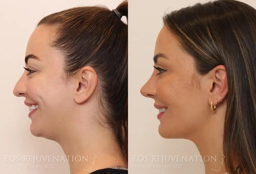 Rhinoplasty Before & After