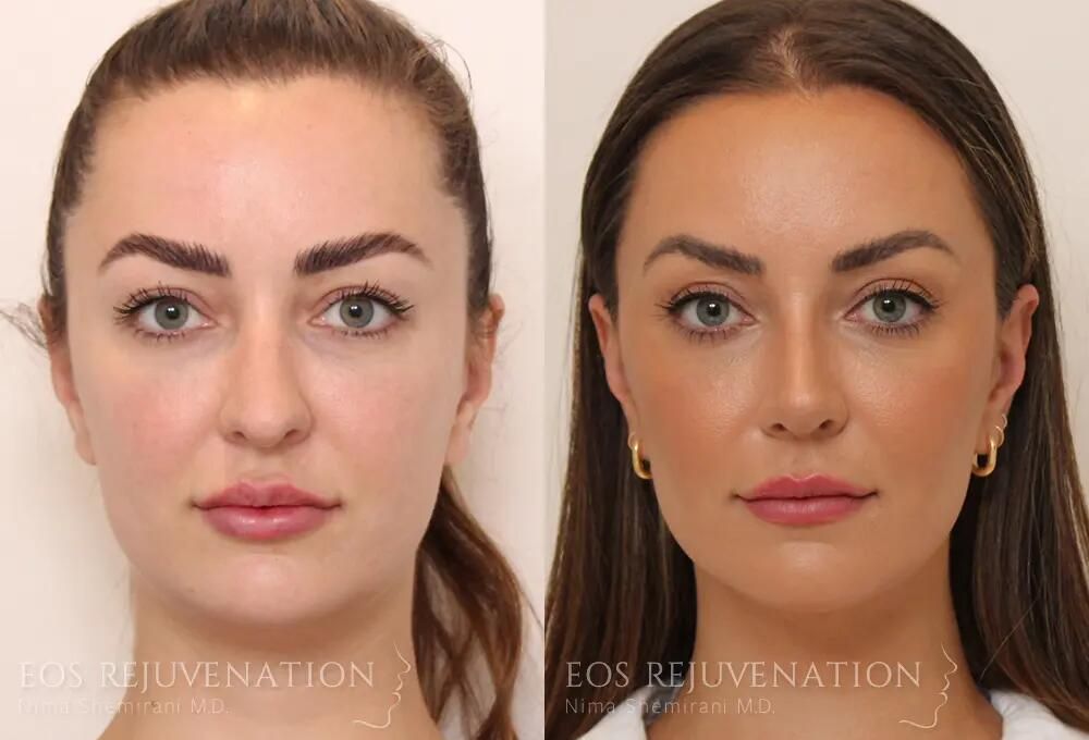 Rhinoplasty Before & After
