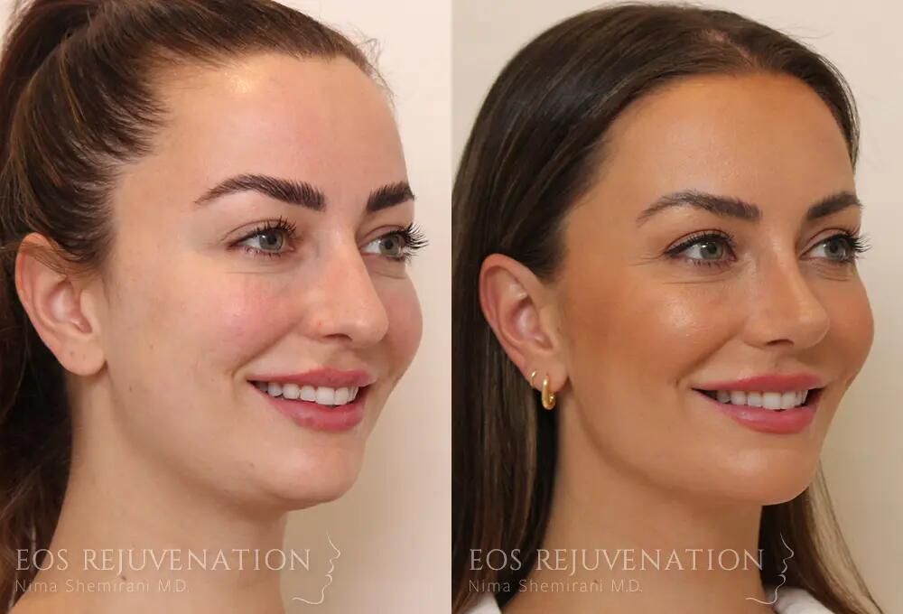 Rhinoplasty Before & After