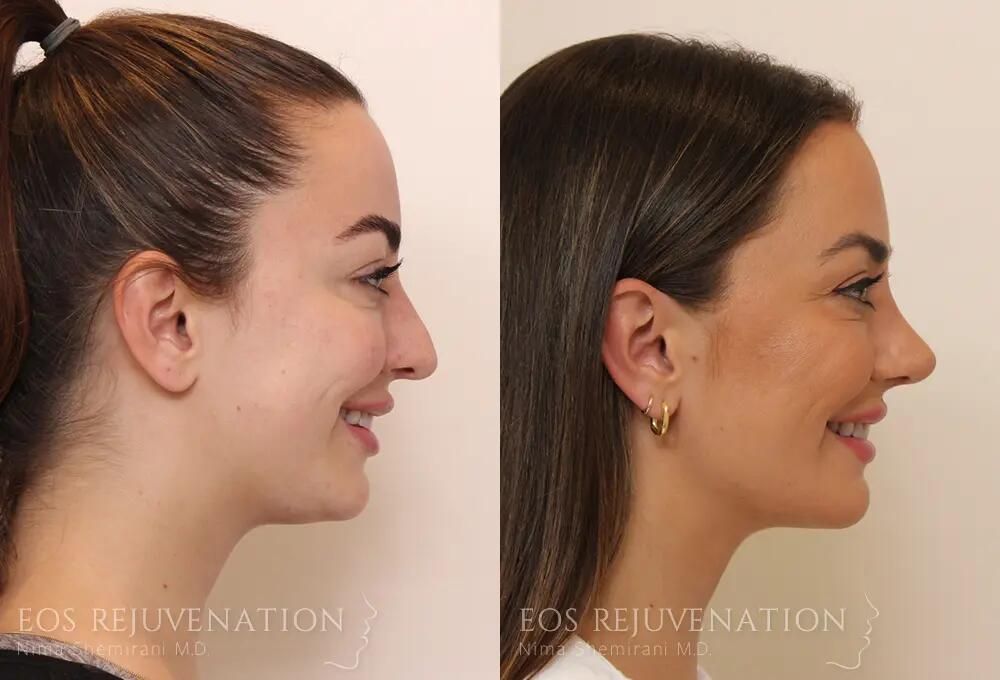 Rhinoplasty Before & After