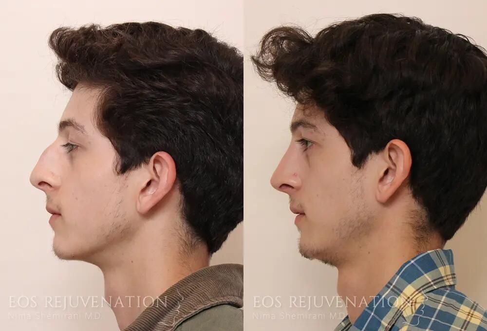 Rhinoplasty Before & After