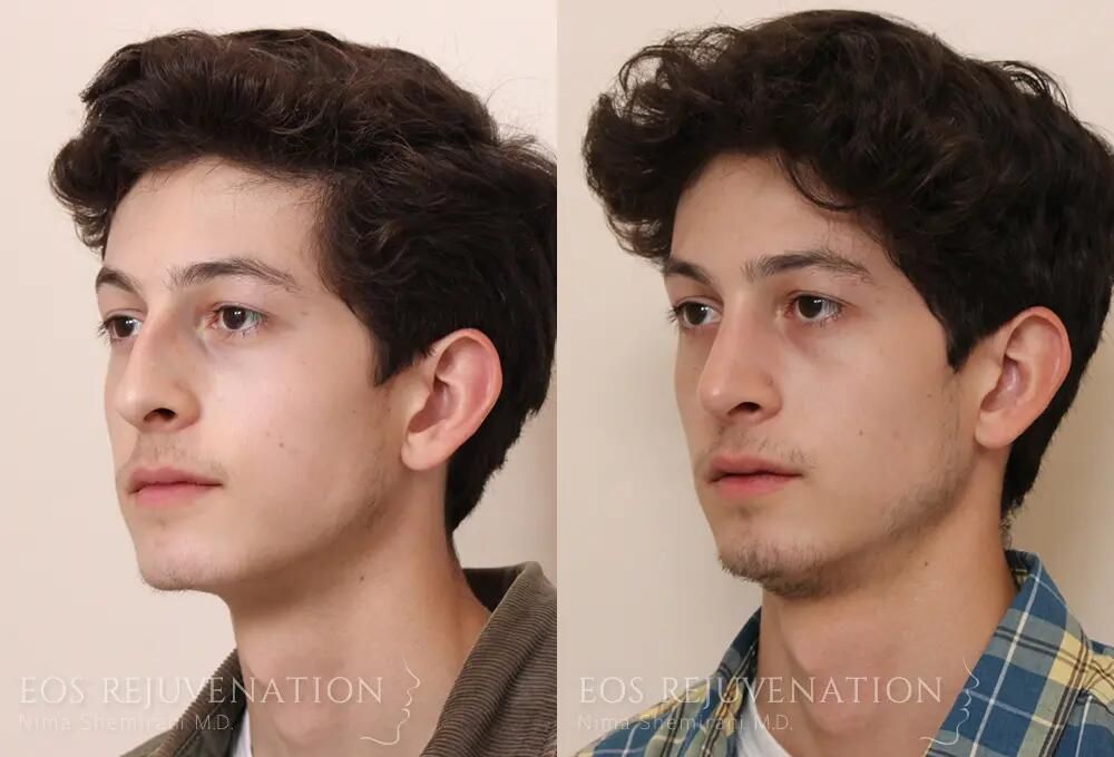 Rhinoplasty Before & After