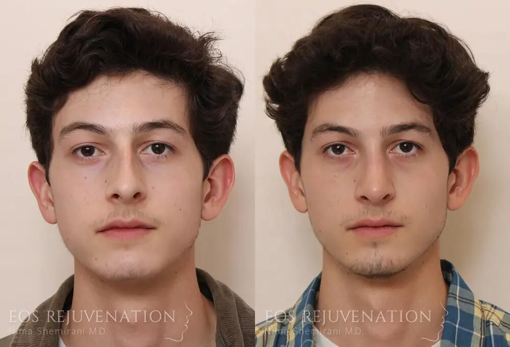 Rhinoplasty Before & After