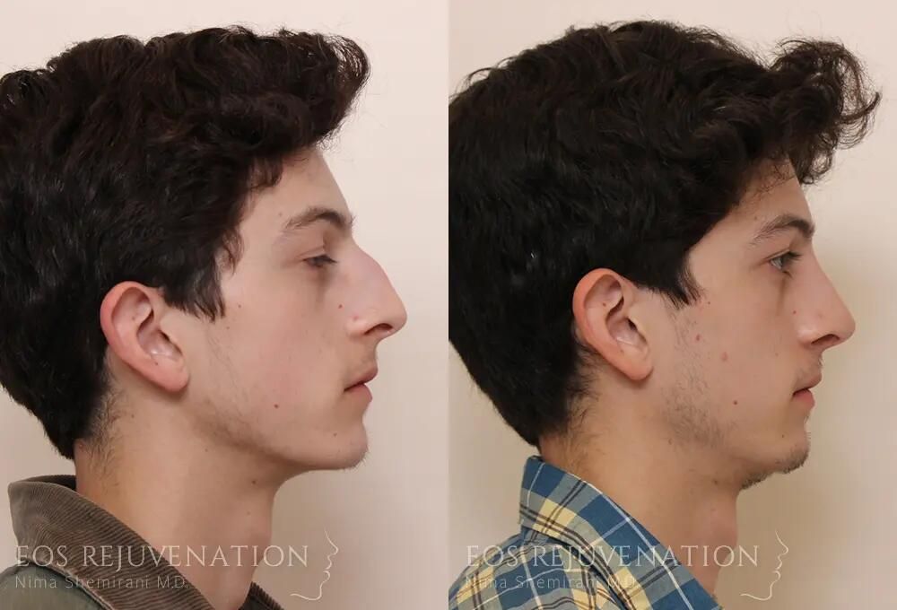 Rhinoplasty Before & After