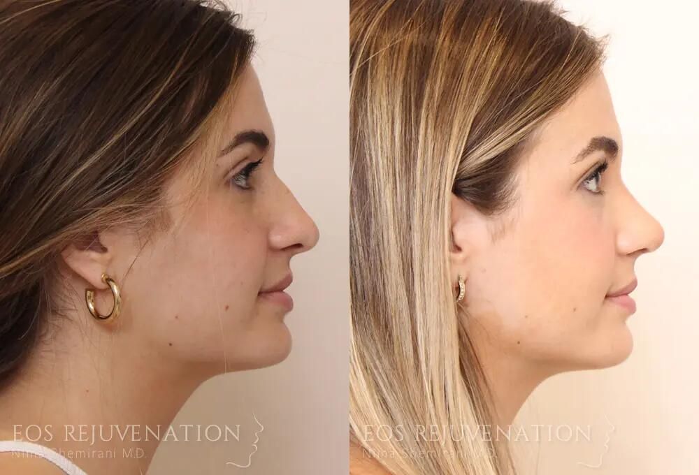 Rhinoplasty Before & After