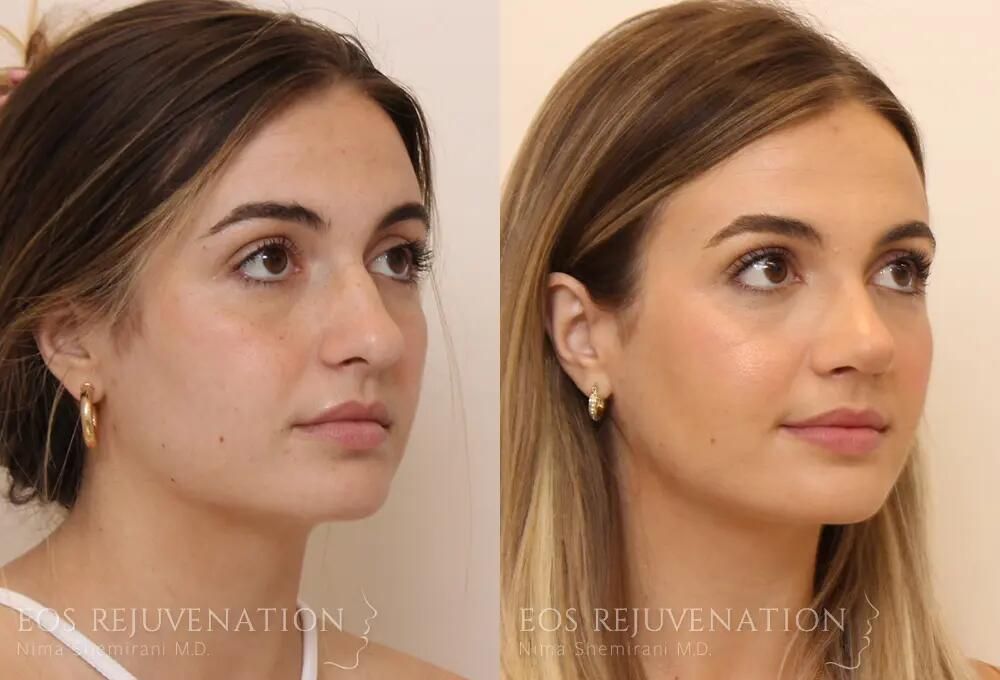 Rhinoplasty Before & After
