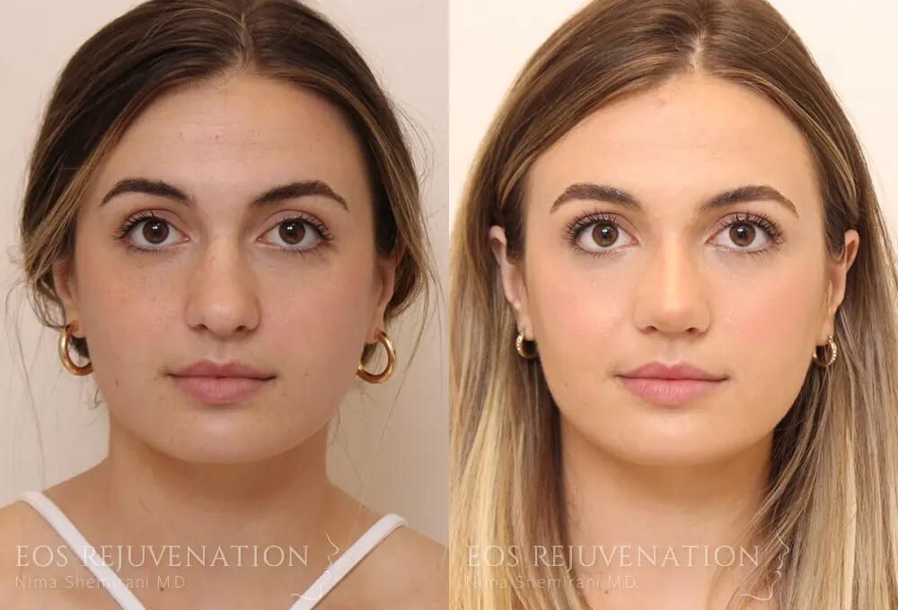 Rhinoplasty Before & After