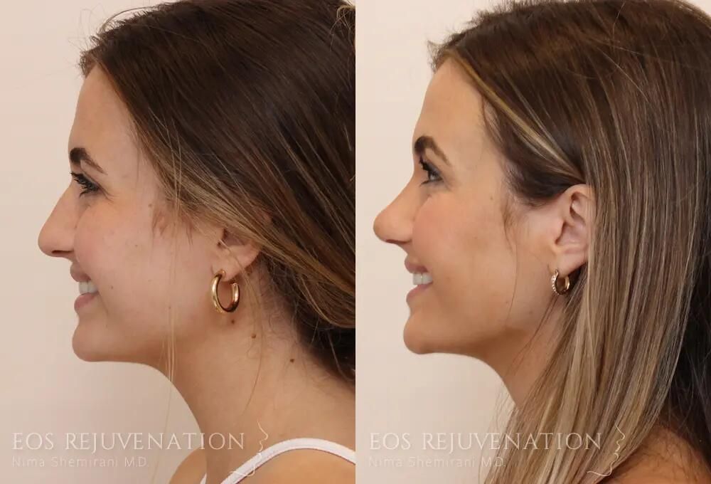 Rhinoplasty Before & After