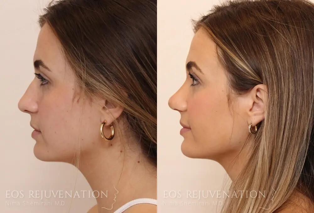 Rhinoplasty Before & After