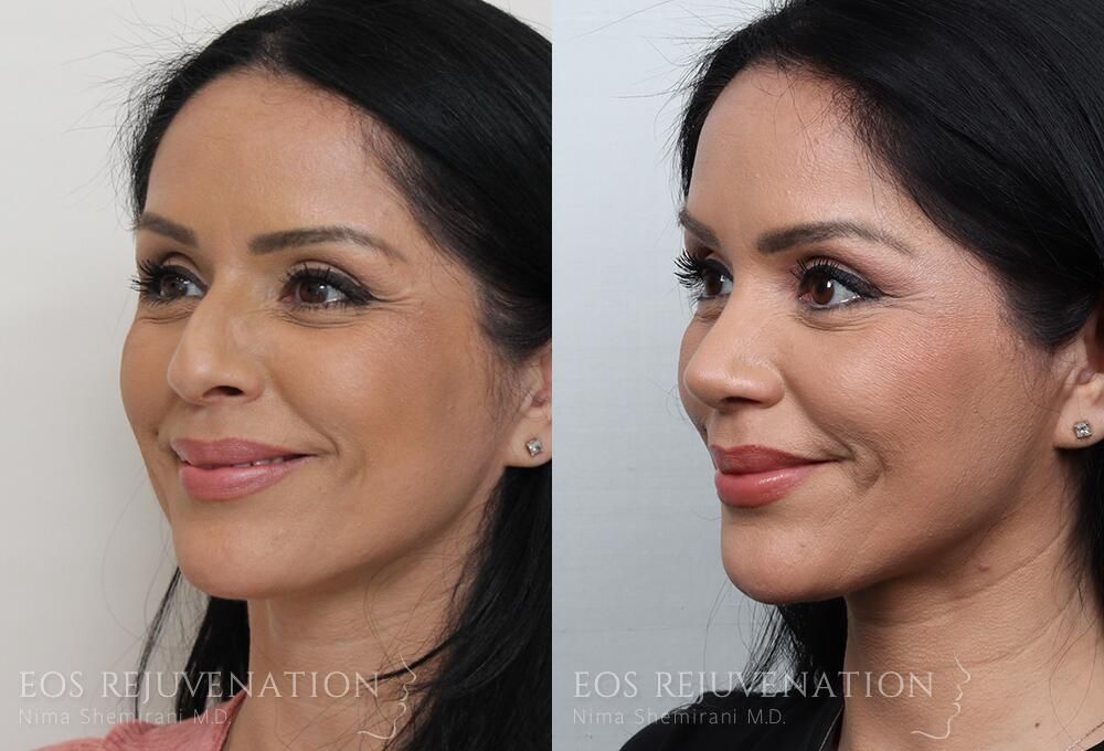 Rhinoplasty Before & After