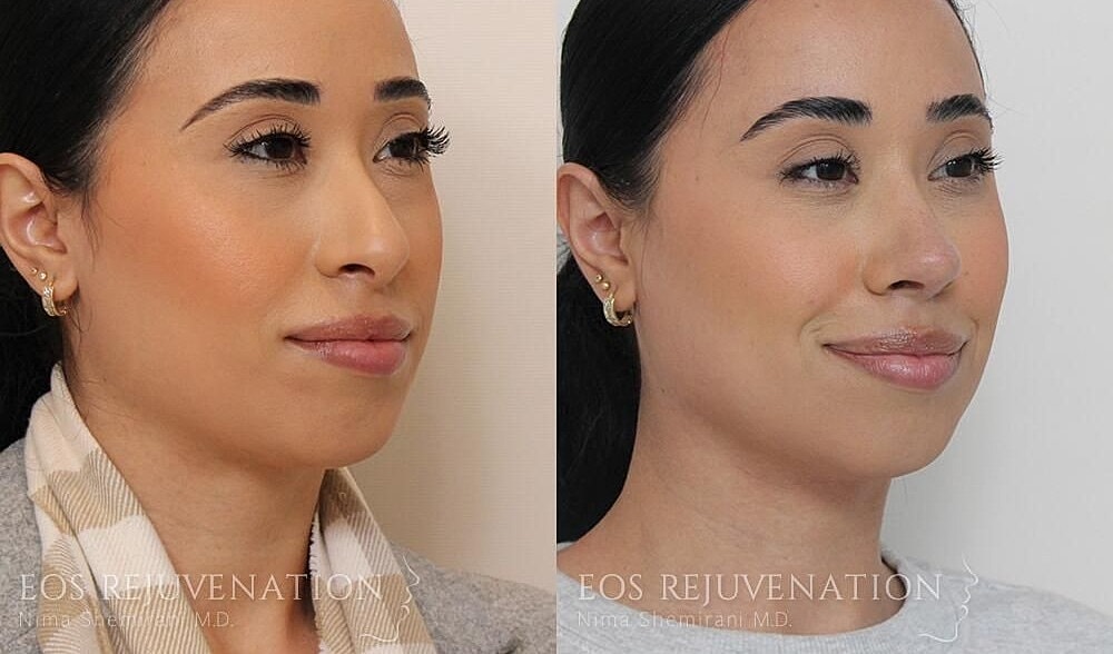 Rhinoplasty Before & After