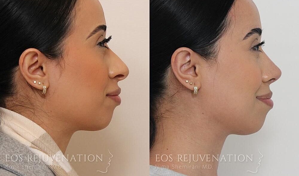 Rhinoplasty Before & After