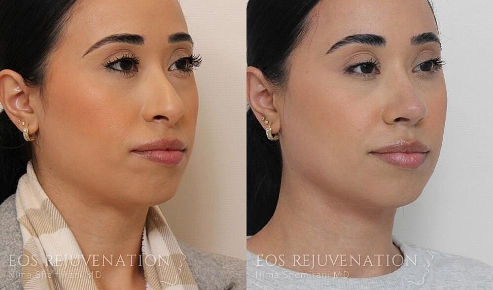 Rhinoplasty Before & After