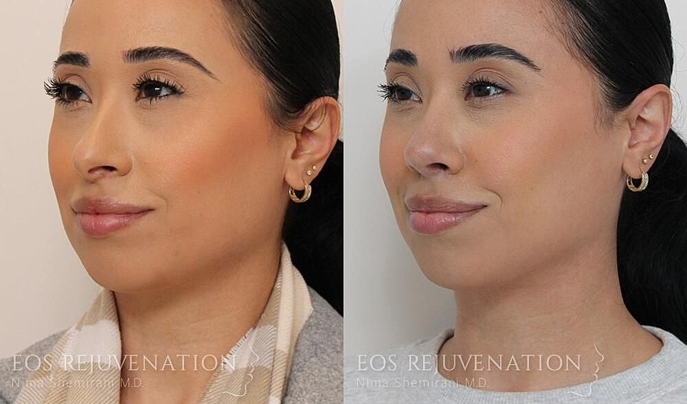 Rhinoplasty Before & After