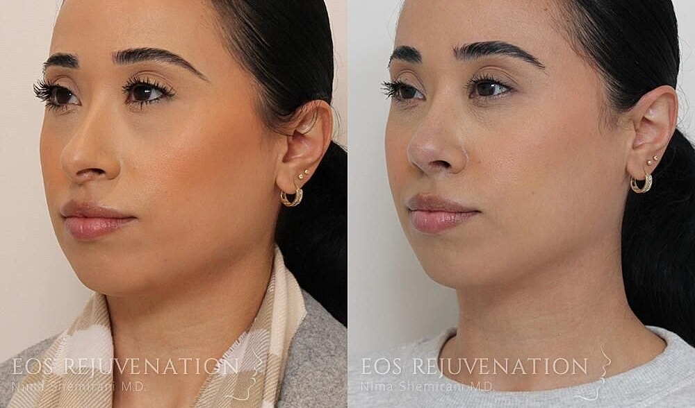 Rhinoplasty Before & After