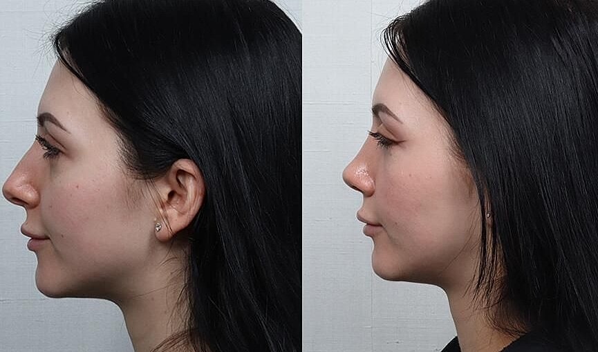 Rhinoplasty Before & After