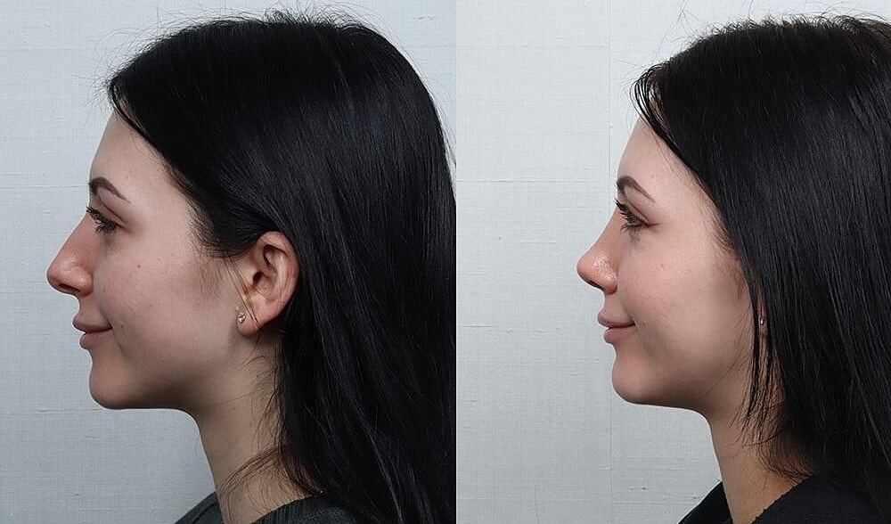 Rhinoplasty Before & After
