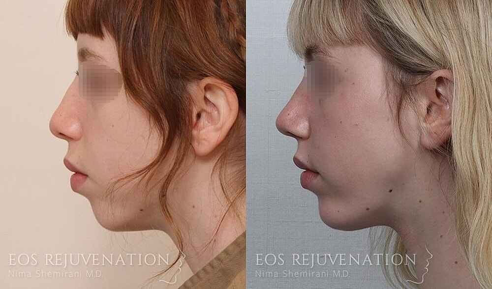 Rhinoplasty Before & After