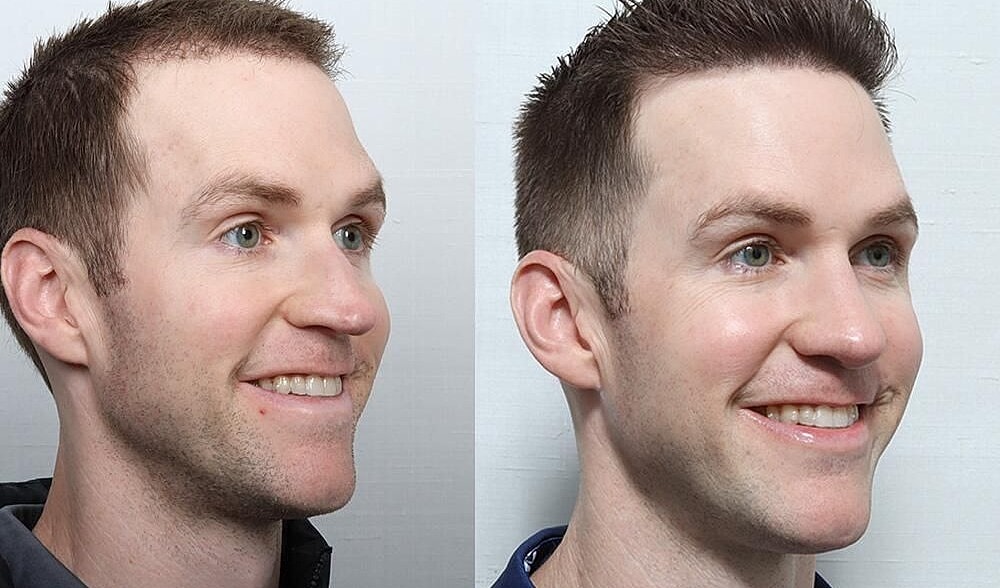 Rhinoplasty Before & After