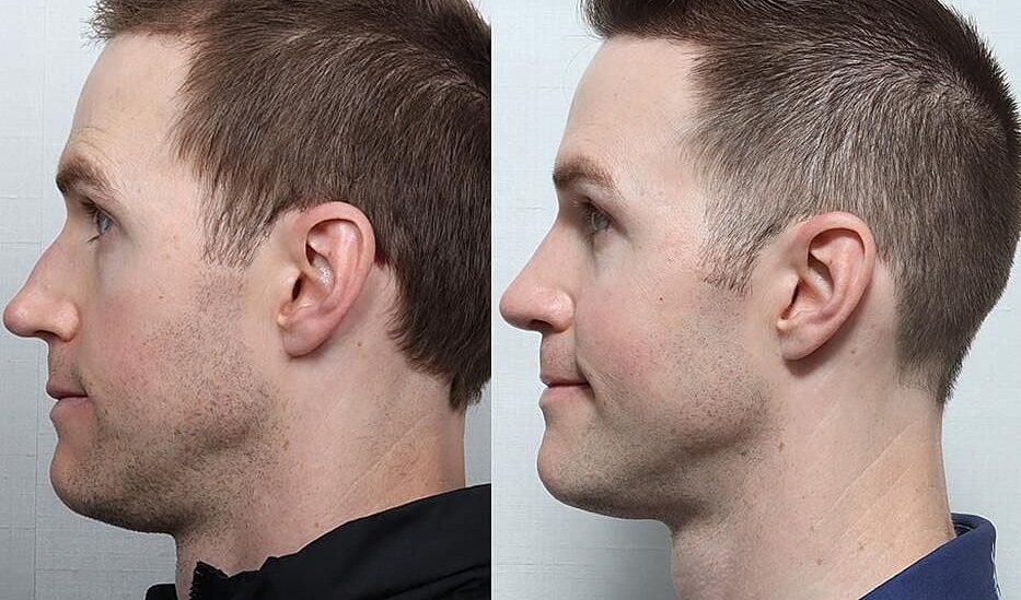 Rhinoplasty Before & After