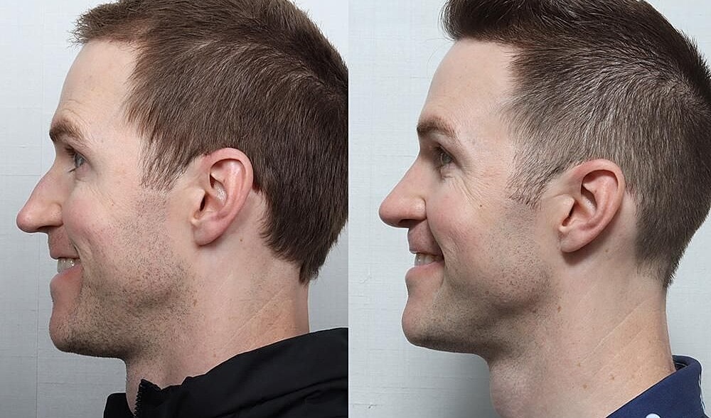 Rhinoplasty Before & After